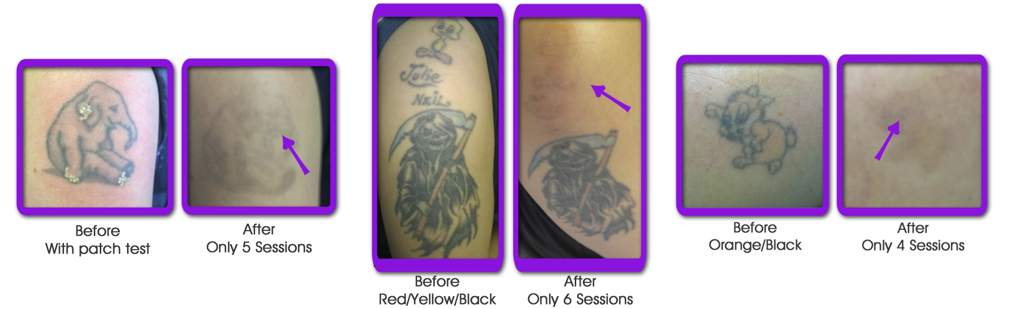 Top Rejuvi Tattoo Removal Images for Pinterest Tattoos