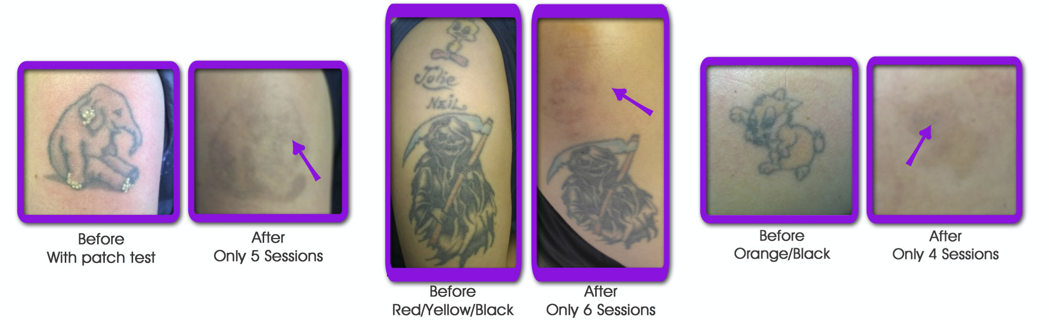 Laser tattoo removal York - Ruby laser Hull clinic