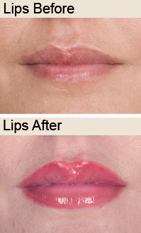 Lips - Before & After