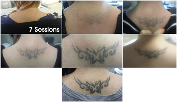 kneck tattoo removal