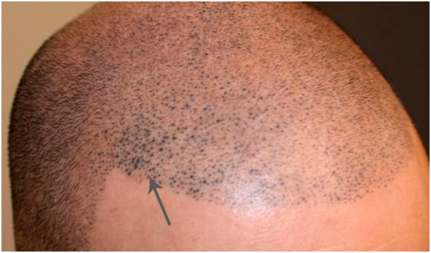 scalp micropigmentation laser removal - Yorkshire