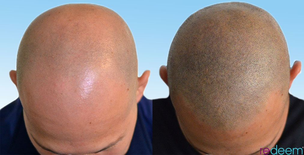 3D scalp micropigmentation