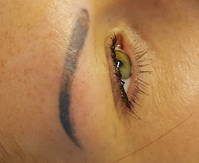 microbladed brows pre laser treatment