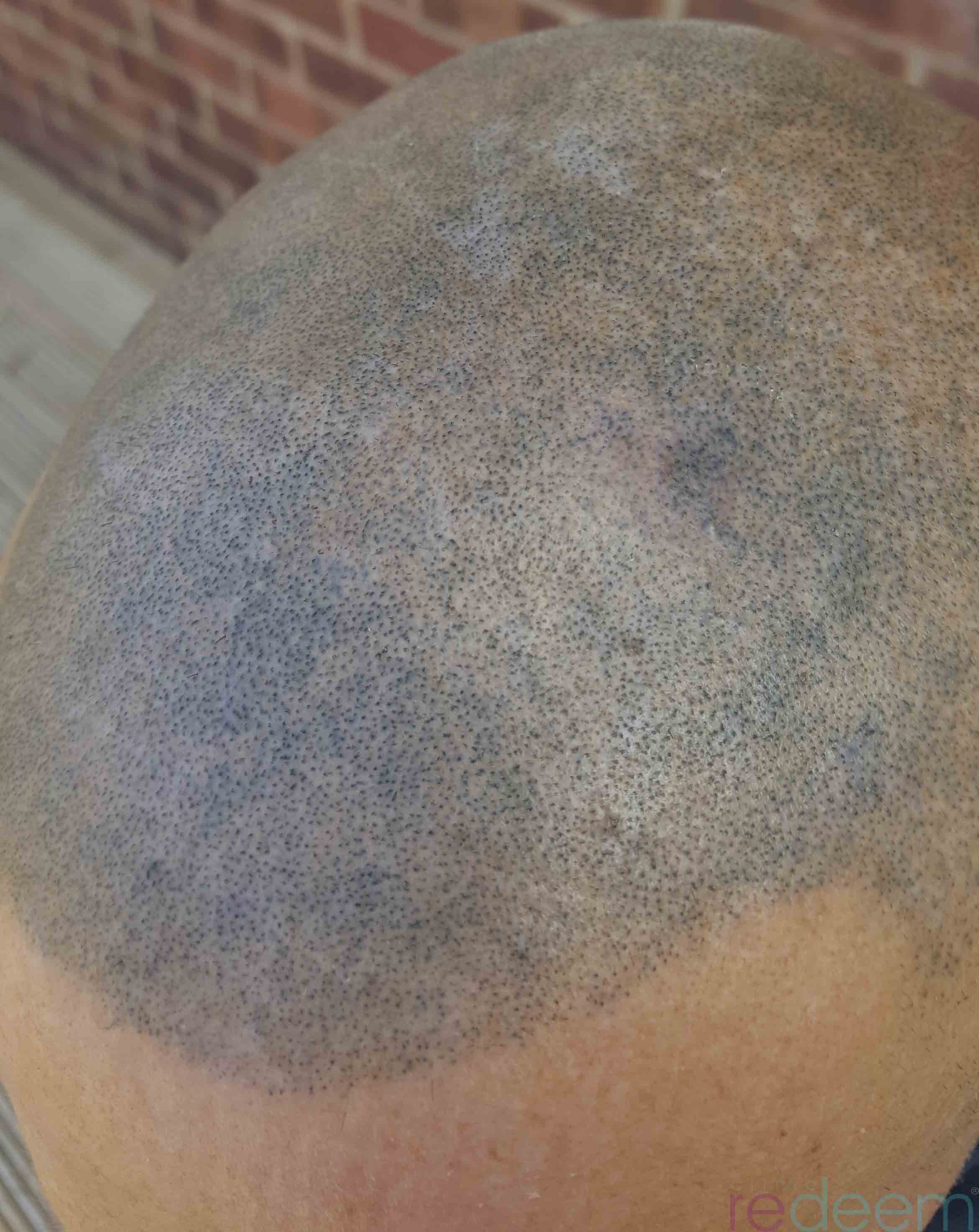 blue scalp micropigmentation