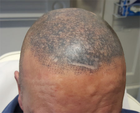 scalp micropigmentation horror