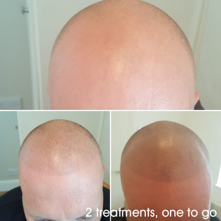 2nd scalp micropigmentation treatment