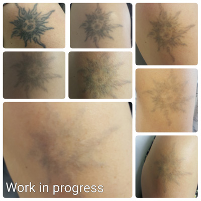 before & after laser tattoo removal