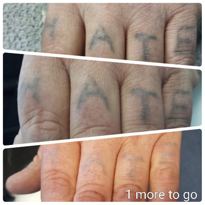 Finger tattoo removal