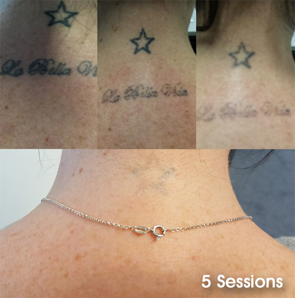 ND yag laser before & After - Redeem Clinic