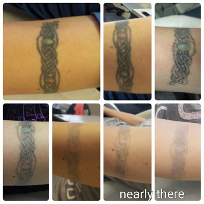 Pico laser tattoo removal - Redeem Clinic