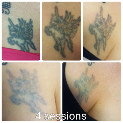 ruby tattoo removal leeds