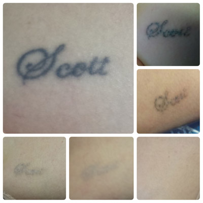 best laser tattoo removal