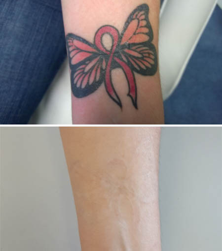 butterfly tattoo removal hull