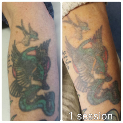 colour tattoo removal