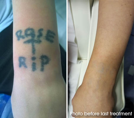home made tattoo removal hull