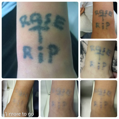 home made tattoo removal