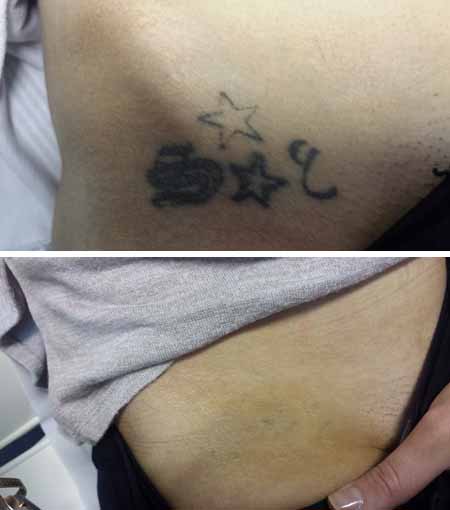 intimate laser tattoo removal hull
