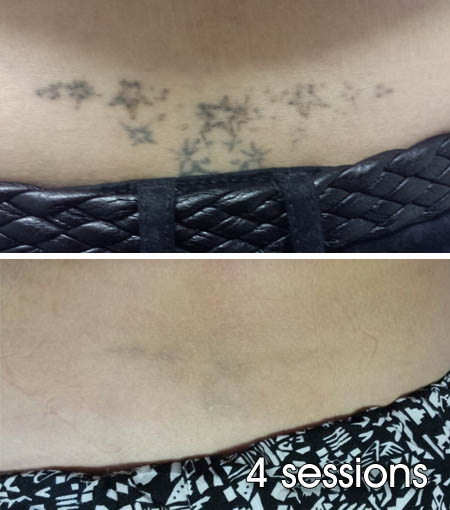 lower back tattoo removal hull