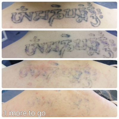 purple tattoo removal