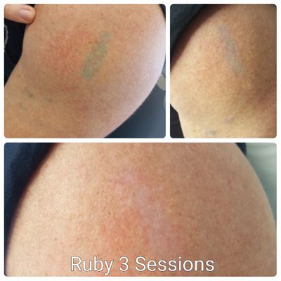 ruby laser tattoo removal hull