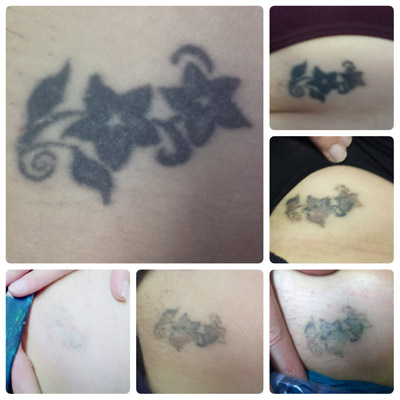 ruby tattoo removal 2