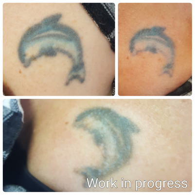 ruby tattoo removal