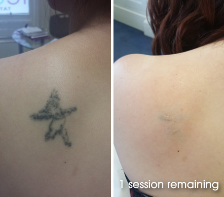 shoulder tattoo removal hull