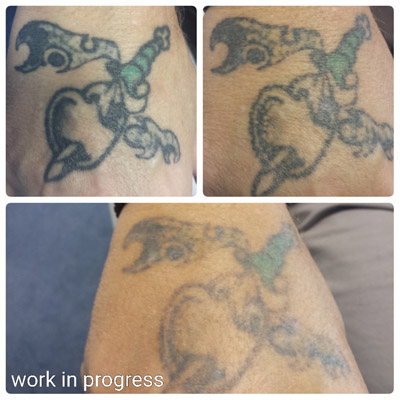 tattoo removal ruby laser