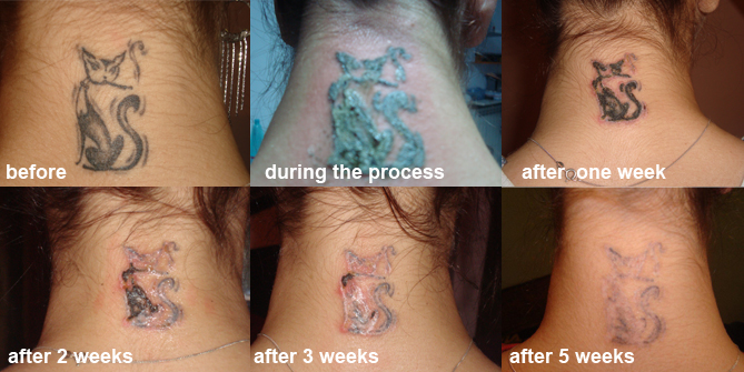 Rejuvi tattoo removal - How it works and which clinic