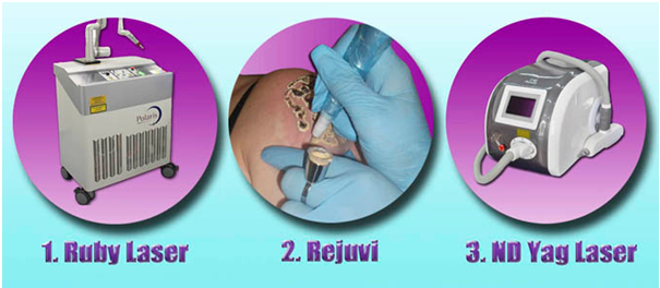 3 x laser tattoo removal types