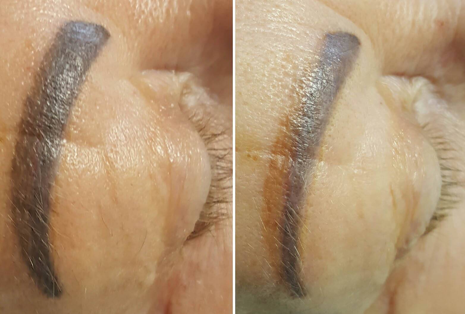 permanent makeup laser removal photo