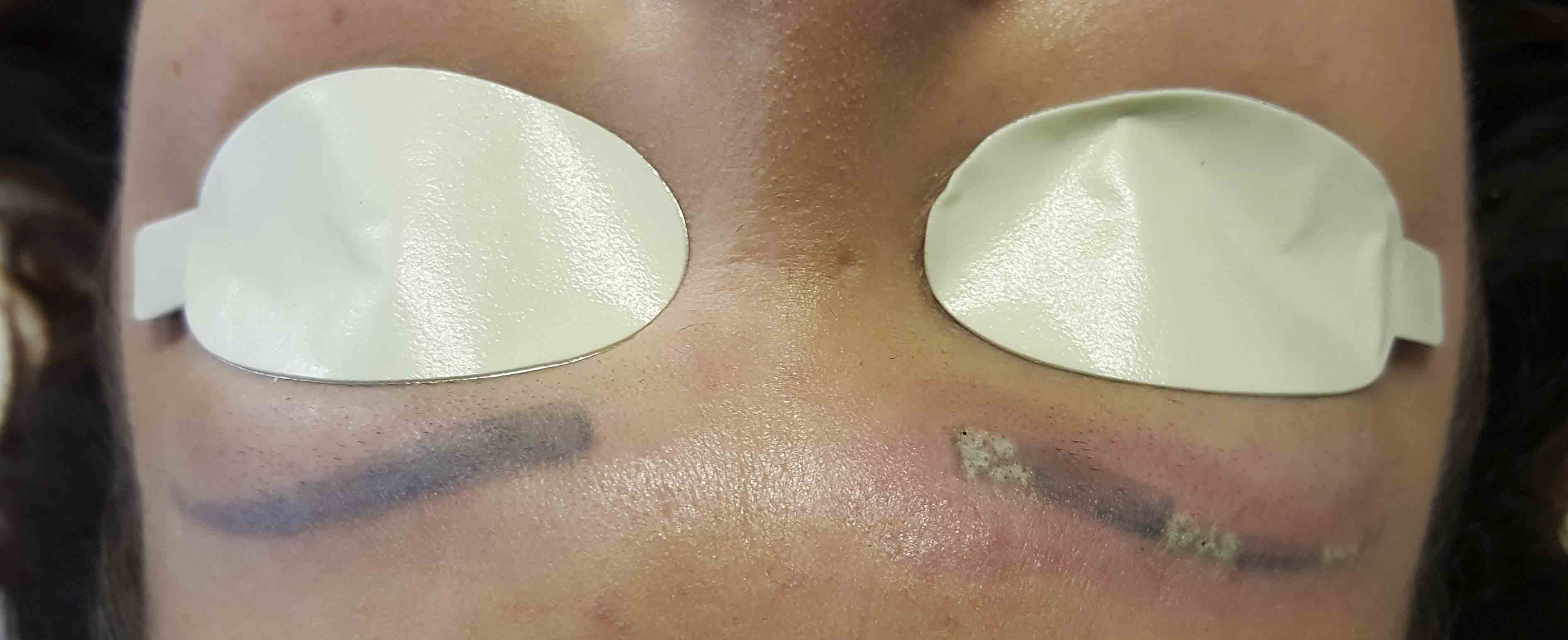 tattooed brows laser removal photo
