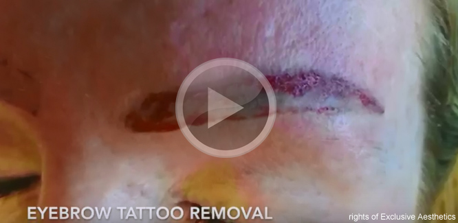 eyebrow tattoo removal - Redeem Clinic