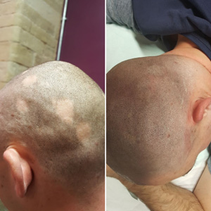alopecia cover up