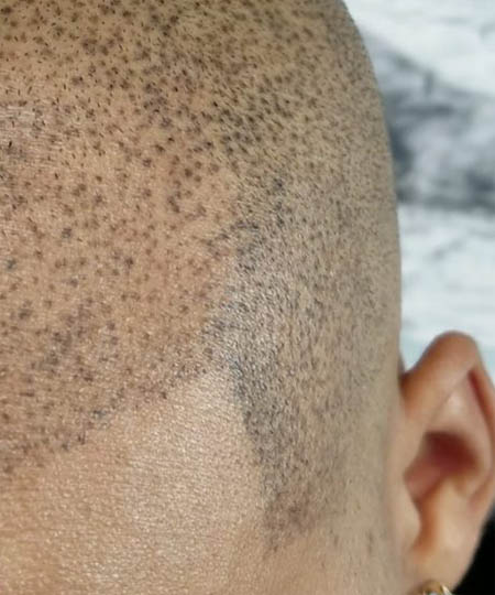 scalp micropigmentation repair